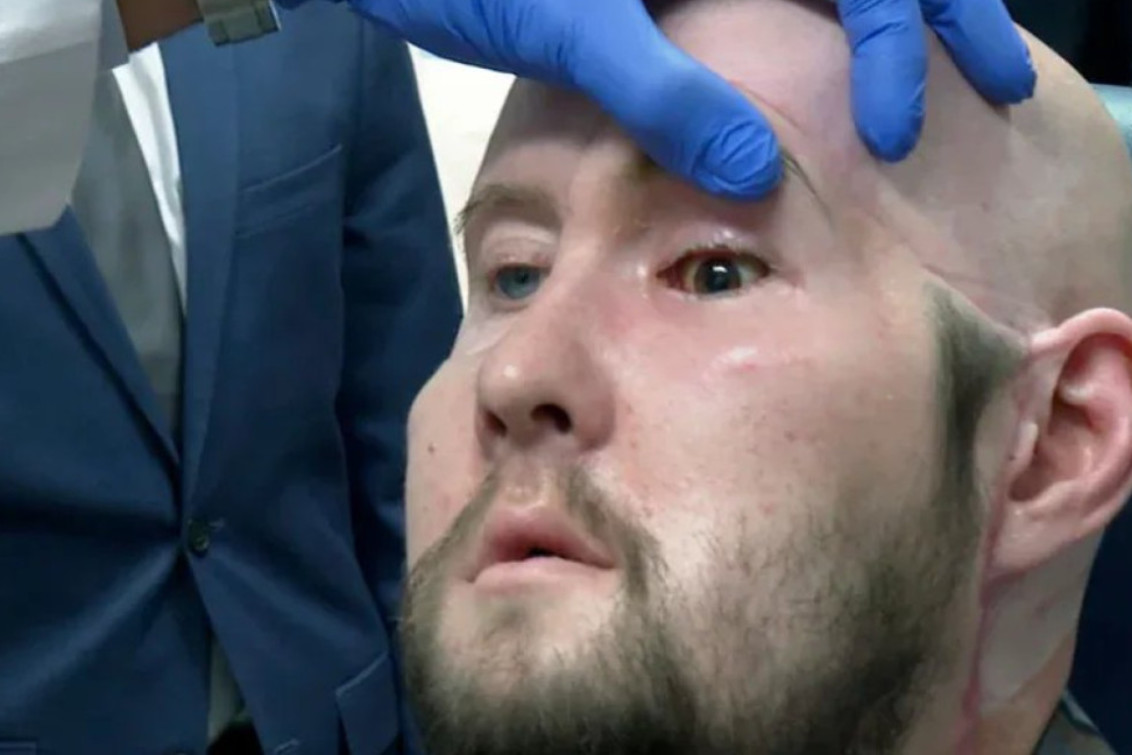 Un hombre recibió el primer trasplante de ojo completo en el mundo
