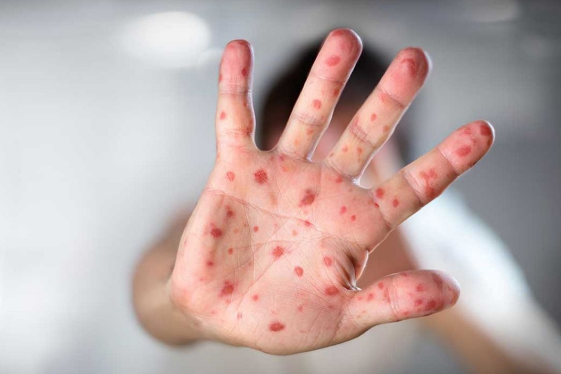 Alerta sanitaria por sarampión: cuatro brotes activos y 500 casos bajo investigación  