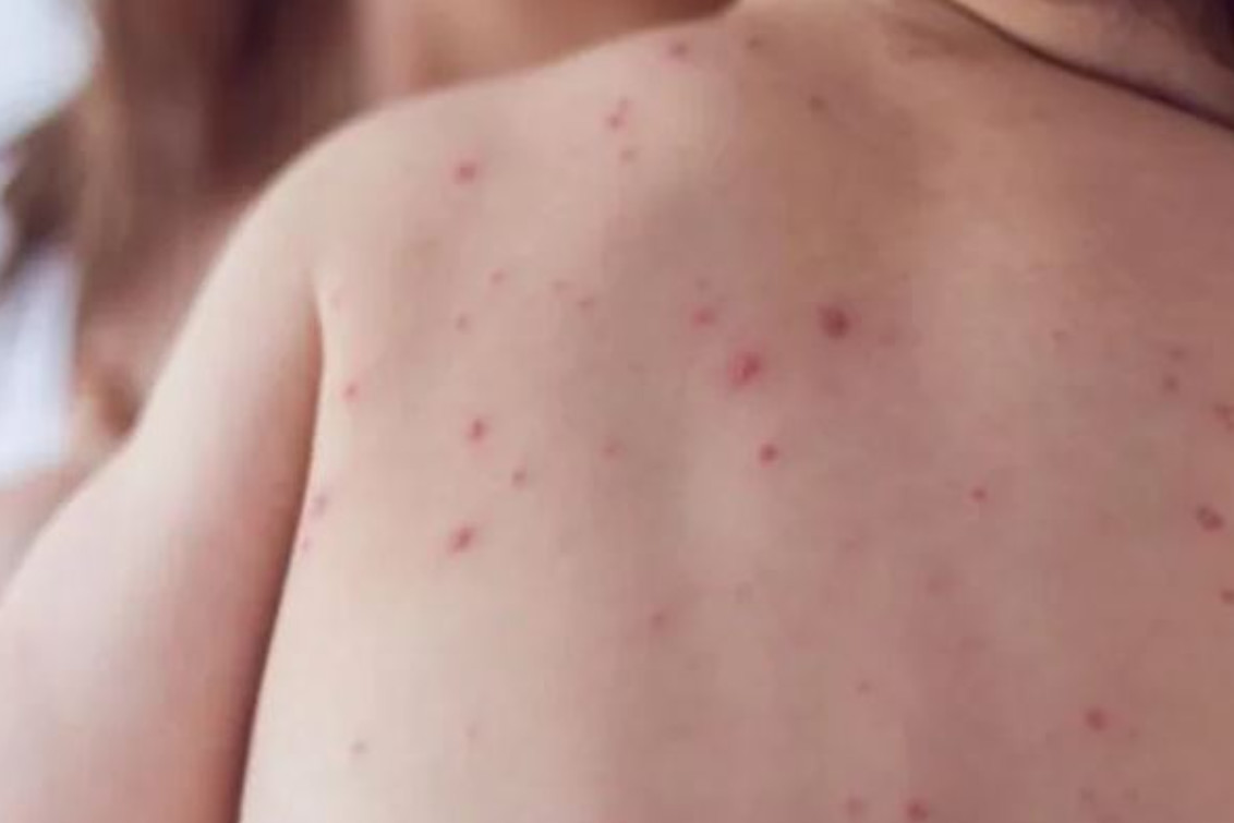 Detectaron un caso de sarampión en Entre Ríos y el Ministerio de Salud reactivó la alerta