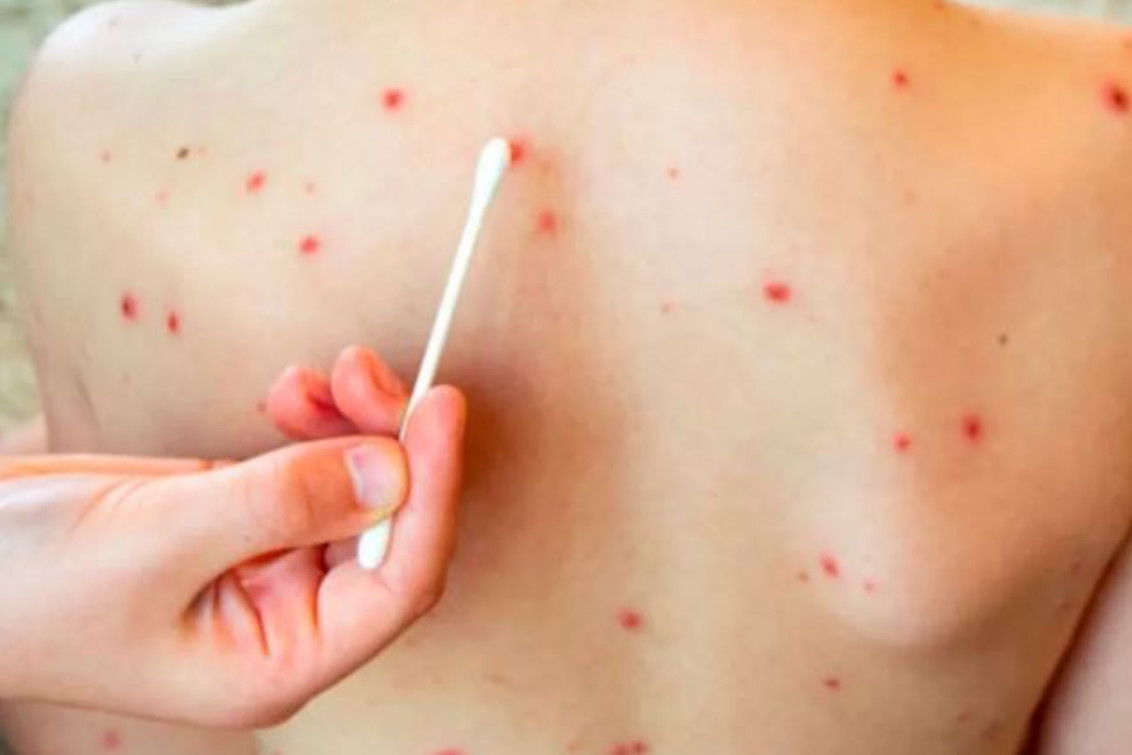 Sarampión: alerta epidemiológica por cuatro nuevos casos